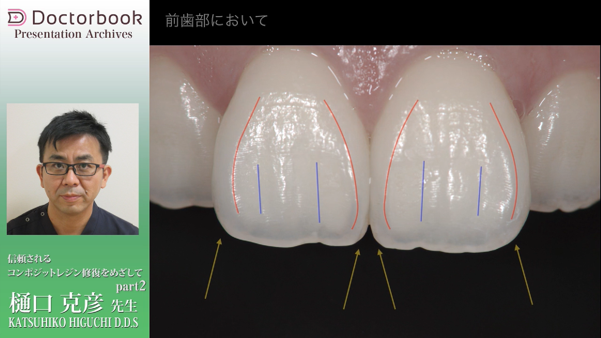 見ないと損！CR修復テクニック～接着と充填の極意～ | Doctorbook